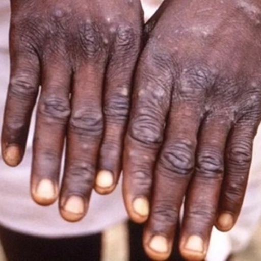 Ep2829: Tin thế giới: Các nước “đổ xô” tích trữ vaccine đậu mùa khỉ, WHO kêu gọi tiếp cận và chia sẻ vaccine công bằng